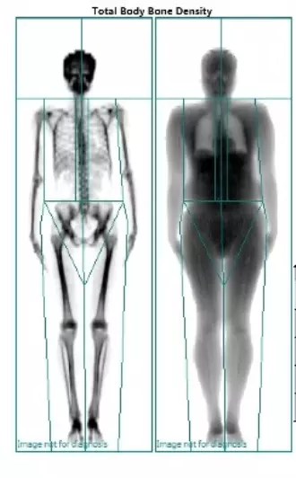 Bone Density DEXA Test in Muzaffarnagar, Best Hospital for Bone Density Test in Muzaffarnagar, Cost of Bone Density Test in Muzaffarnagar, Best DEXA Scan Centre in Uttar Pradesh