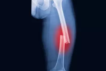 Fracture Surgery India, Best Hospital for Fracture Surgery in India, Best Doctor for Fracture Surgery in India, Cost of Fracture surgery in muzaffarnagar india