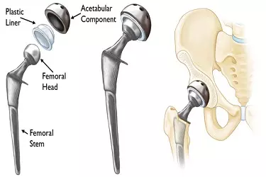 Revision Knee Replacement Surgery India, Revision Hip Replacement Surgery India, Best Hospital for Revision Knee Hip Surgery in India, Best Doctor for Revision Knee Hip Surgery in India, Cost of Revision Knee Hip Surgery in muzaffarnagar india